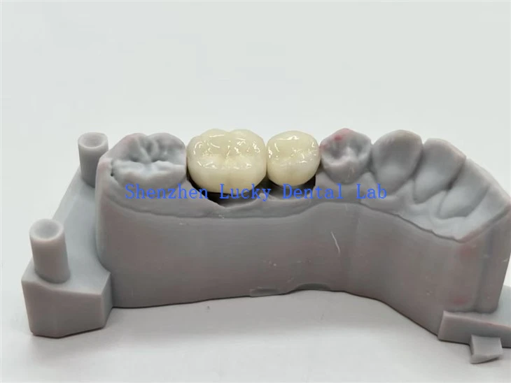 CoCr sulamist PFM hambakroonid
