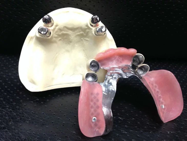 Naturaalne pall kinnitus üledentuur